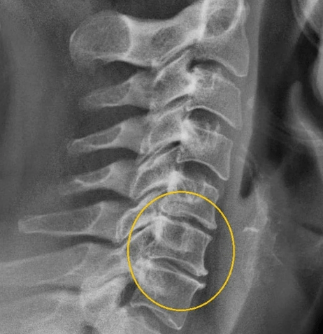 cervical osteochondrosis